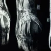 Radiographie en gros plan montrant une vue détaillée des os de la main humaine.