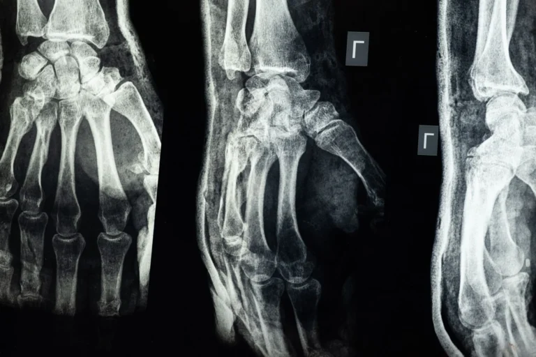 Fractures osseuses : comprendre, diagnostiquer et traiter
