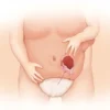 Hernie diaphragmatique congénitale : causes, diagnostic et prise en charge