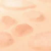Kératose actinique : causes, symptômes, diagnostic et traitements