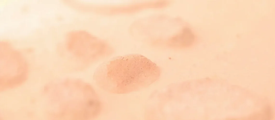 Kératose actinique : causes, symptômes, diagnostic et traitements
