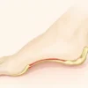 La sésamoïdite : comprendre, traiter et prévenir cette inflammation du pied