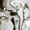 IRM cérébrale en coupe sagittale montrant l'anatomie du cerveau humain pour analyse