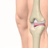 Le ligament croisé postérieur : anatomie, blessures et traitement