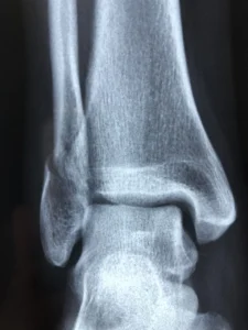 Le Talus : anatomie et pathologies de l'Os de la Cheville