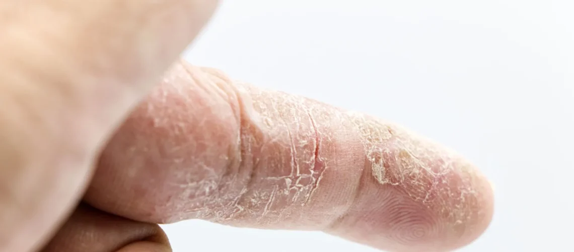 Gros plan détaillé d'un doigt humain à la peau sèche et calleuse, montrant la texture et l'état de la peau.