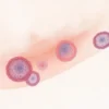 Leishmaniose viscérale : causes, symptômes, diagnostic et traitement