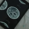 Gros plan sur un scanner cérébral affiché sur une tablette numérique avec une aiguille médicale à côté.