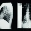 Radiographie haute résolution montrant un examen détaillé de la colonne vertébrale avec scoliose