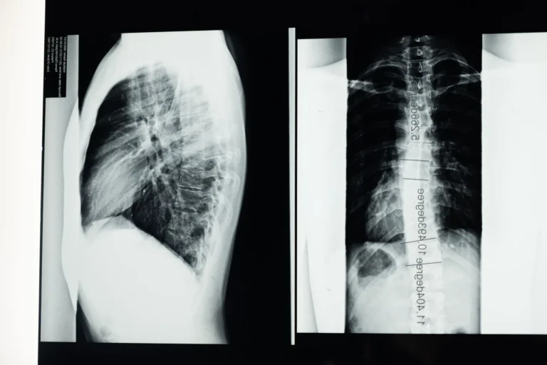 Les vertèbres thoraciques T1 à T12 : anatomie et pathologies