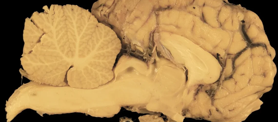 L'espace sous-dural : anatomie, fonctions et pathologies