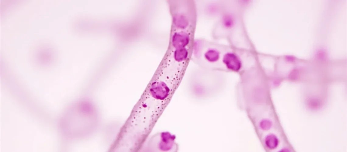 Leucémie prolymphocytaire : symptômes, diagnostic et traitements