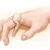 Maladie de Dupuytren : causes, symptômes, diagnostic et traitements