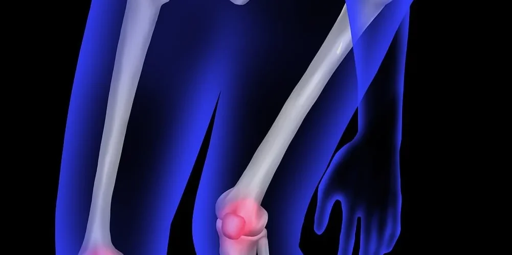 Maladie d'Osgood-Schlatter : causes, symptômes et traitements