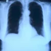Mésothéliome pleural : causes, symptômes, diagnostic et traitements