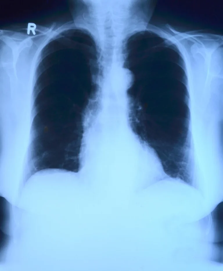 Mésothéliome pleural : causes, symptômes et traitements