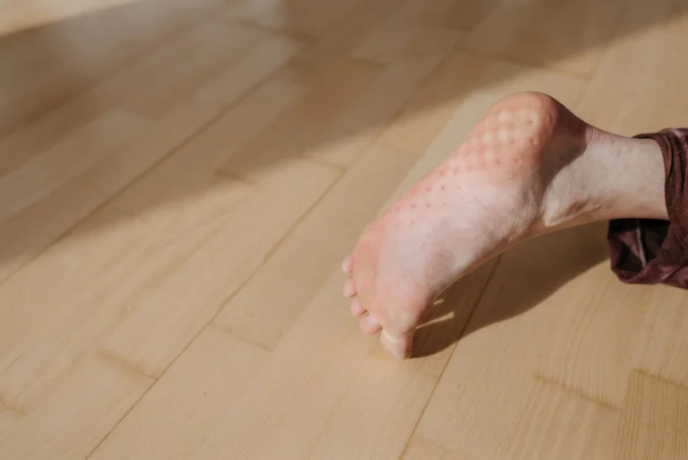 Pied creux : causes, symptômes, diagnostic et traitements
