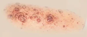 Psoriasis pustuleux : causes, formes cliniques et diagnostic