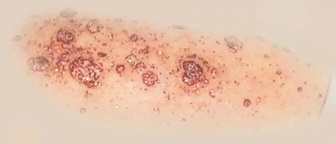 Psoriasis pustuleux : causes, formes cliniques et diagnostic