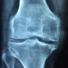 Rhumatisme psoriasique : symptômes, diagnostic et traitements