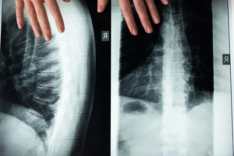 Spondylarthrite ankylosante : comprendre et traiter
