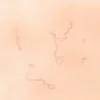 Syndrome d'épidermolyse staphylococcique : causes, symptômes et traitement