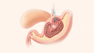 Canal de Wirsung : anatomie, fonction et pathologies
