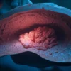 Carcinose péritonéale : causes, symptômes, diagnostic et traitements