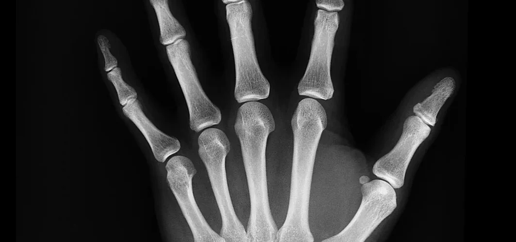 Cartilage épiphysaire : structure, fonction et pathologies de la plaque de croissance
