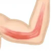 Épicondylite : causes, symptômes et traitements efficaces