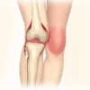 Genu valgum : causes, diagnostic et traitements des genoux en X