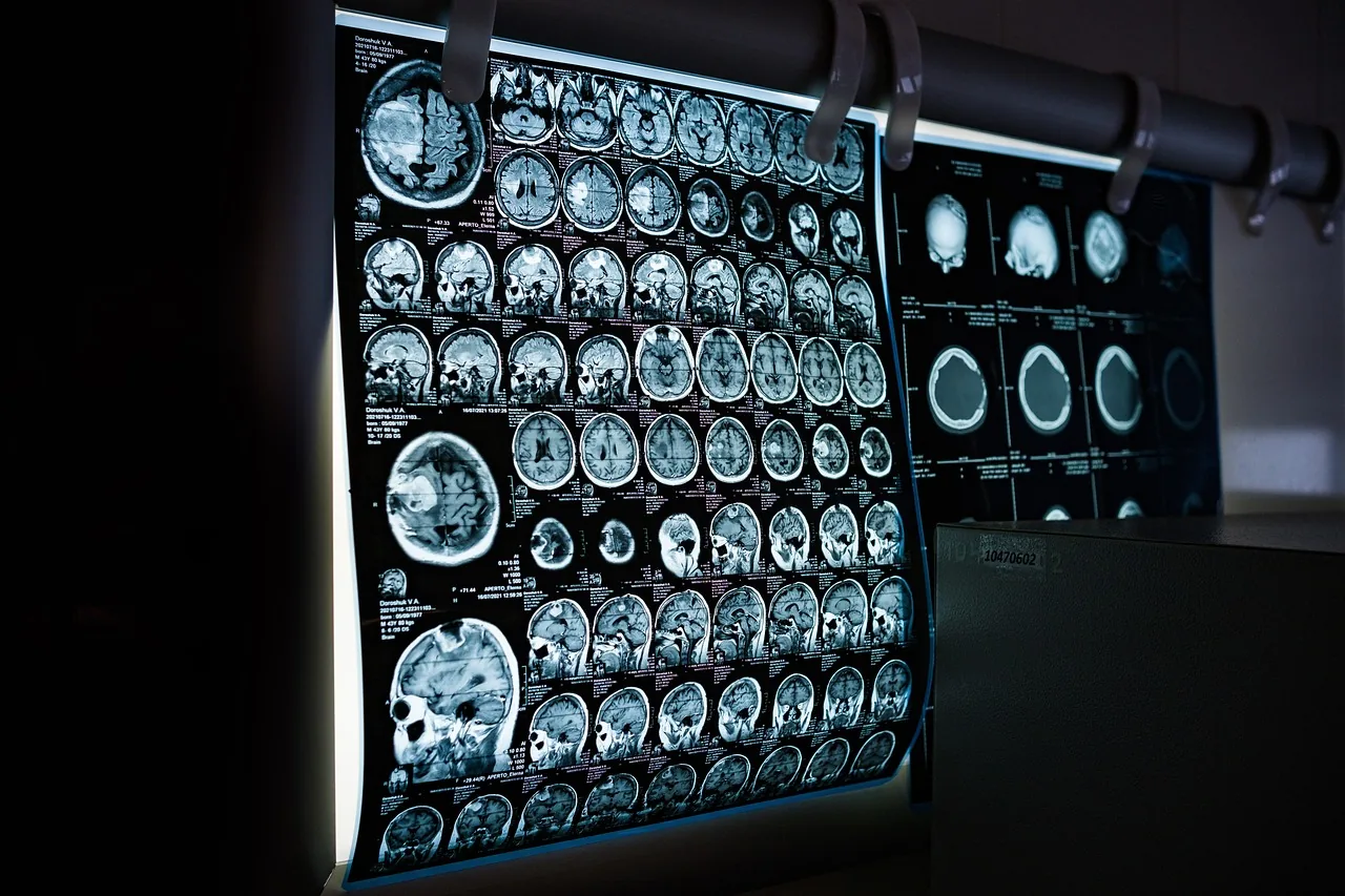 Hématome sous-dural : causes, symptômes et traitement