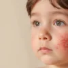 Le lichen plan chez l&rsquo;enfant : comprendre, reconnaître et traiter cette affection cutanée