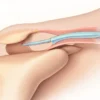 Le ligament coraco-acromial : anatomie, fonctions et pathologies