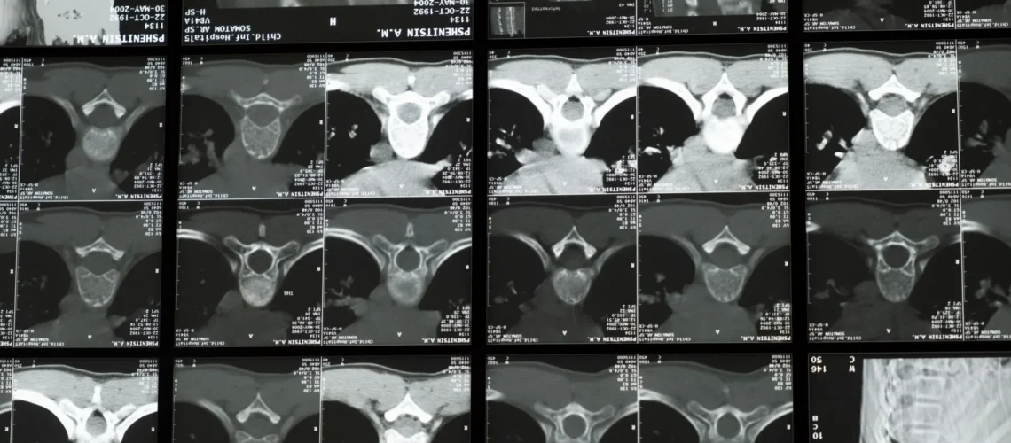 Images radiologiques haute résolution montrant la structure complexe de la colonne vertébrale humaine pour un examen médical.