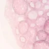 Lymphome T : comprendre cette forme rare de cancer du sang