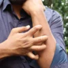 Un homme en chemise bleue se gratte le bras en extérieur, mettant en évidence une irritation cutanée.