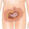 Mésothéliome péritonéal : causes, symptômes, diagnostic et traitements