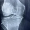 Rhumatisme palindromique : symptômes, diagnostic et traitements