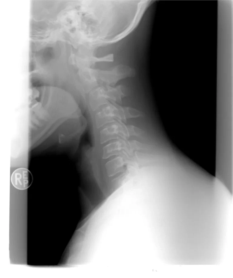 Spondylolisthésis : causes, symptômes et traitements