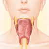 Thyroïdite de Riedel : comprendre cette fibrose thyroïdienne rare
